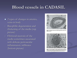 Blood vessels in CADASIL
 2 types of changes in arteries,
veins in body
1. Basophilic degeneration and
thickening of the media (top
picture)
2. Fibrinoid necrosis of the
media sometimes associated
with delicate perivascular
inflammatory infiltrates
(bottom picture)
 