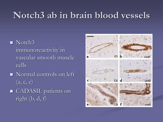 Notch3 ab in brain blood vessels
 Notch3
immunoreactivity in
vascular smooth muscle
cells
 Normal controls on left
(a, c, e)
 CADASIL patients on
right (b, d, f)
 