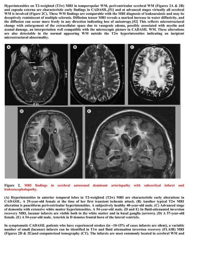 Topic of the month.... Hereditary subcortical vascular dementia (CADASIL)