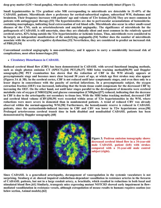 Topic of the month.... Hereditary subcortical vascular dementia (CADASIL)