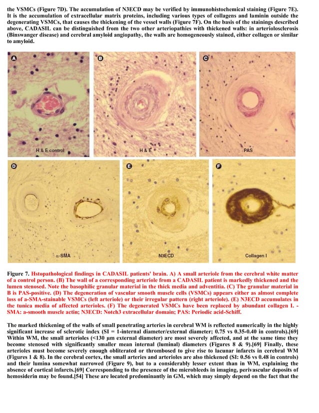Topic of the month.... Hereditary subcortical vascular dementia (CADASIL)