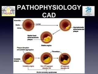 CAD & CABG | PPTX