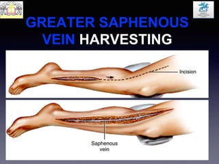 GREATER SAPHENOUS
VEIN HARVESTING
 