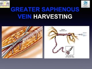 GREATER SAPHENOUS
VEIN HARVESTING
 