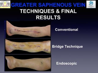 GREATER SAPHENOUS VEIN
TECHNIQUES & FINAL
RESULTS
Conventional
Bridge Technique
Endoscopic
 