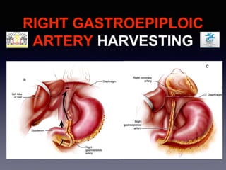 RIGHT GASTROEPIPLOIC
ARTERY HARVESTING
 