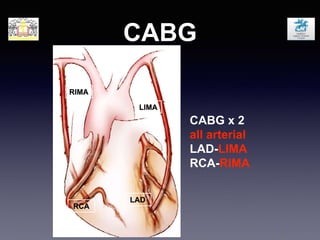 CABG
LAD
LIMA
RIMA
CABG x 2
all arterial
LAD-LIMA
RCA-RIMA
RCA
 