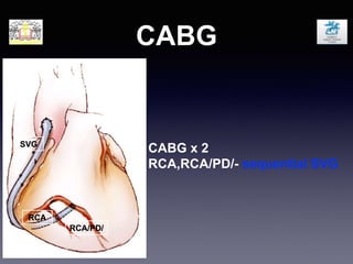 CABG
RCA/PD/
SVG
CABG x 2
RCA,RCA/PD/- sequential SVG
RCA
 