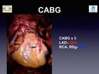 CABG
LIMA
SVG
CABG x 3
LAD-LIMA
RCA, RDg-SVG
SVG
 