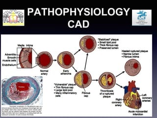 CAD & CABG | PPTX