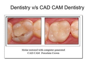 Cad Cam dentistry and digital impressions | PPTX