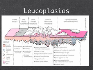 Leucoplasias
Displasia
Sem Displasia
Leve
Moderada
Grave
Ca in situ
 