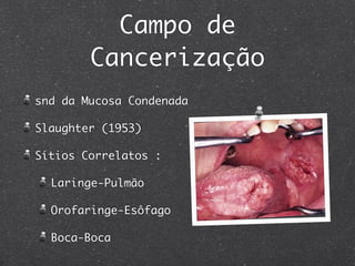 Campo de
Cancerização
snd da Mucosa Condenada
Slaughter (1953)
Sítios Correlatos :
Laringe-Pulmão
Orofaringe-Esôfago
Boca-Boca
 