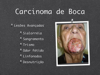 Carcinoma de Boca
Lesões Avançadas
Sialorréia
Sangramento
Trismo
Odor fétido
Linfonodos
Desnutrição
 