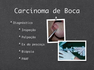 Carcinoma de Boca
Diagnóstico
Inspeção
Palpação
Ex do pescoço
Biópsia
PAAF
 
