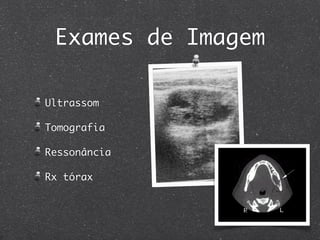 Exames de Imagem
Ultrassom
Tomografia
Ressonância
Rx tórax
 