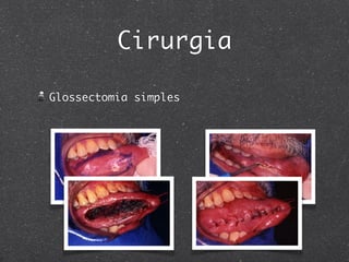 Cirurgia
Glossectomia simples
 