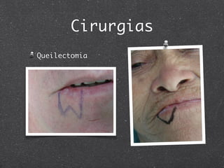 Cirurgias
Queilectomia
 