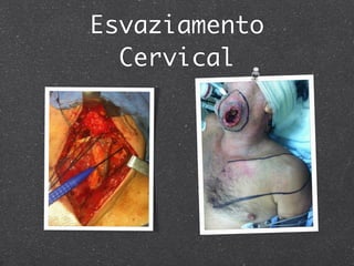 Esvaziamento
Cervical
 