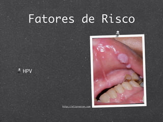 Fatores de Risco
HPV
http://ellurezion.com
 