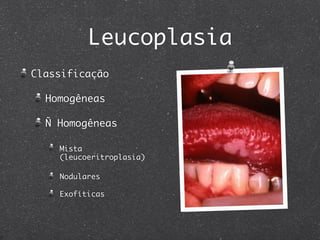 Leucoplasia
Classificação
Homogêneas
Ñ Homogêneas
Mista
(leucoeritroplasia)
Nodulares
Exofíticas
 