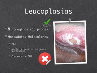 Leucoplasias
Ñ homogênas são piores
Marcadores Moleculares
P53
perda heterozito em genes
suressores
Conteúdo de DNA
 