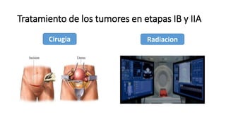 Tratamiento de los tumores en etapas IB y IIA
Cirugia Radiacion
 