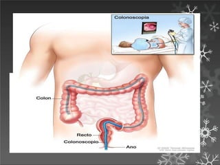 DIAGNOSTICO
Cuadro clinico
Confirmacion colonoscopia y Biopsia
Laboratorios Hemograma, Funcion hepatica, parcial de
orina
Sigmoidoscopia
Enema baritado
CEA
Estudios por imagenes
 