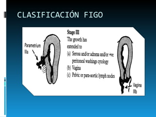 CLASIFICACIÓN FIGO 
