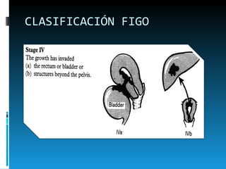 CLASIFICACIÓN FIGO 