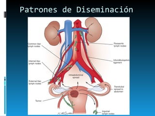 Patrones de Diseminación 
