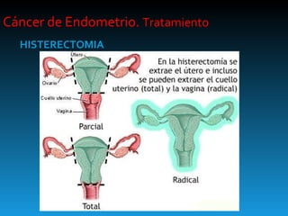 Cáncer de Endometrio.  Tratamiento HISTERECTOMIA 