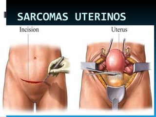 SARCOMAS UTERINOS 