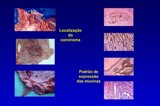 Localização
     do
 carcinoma




         Padrão de
         expressão
        das mucinas
 