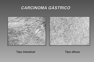CARCINOMA GÁSTRICO




Tipo intestinal   Tipo difuso
 