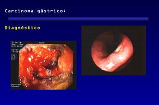 Carcinoma gástrico:


Diagnóstico
 