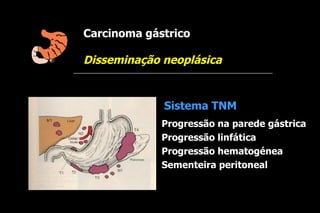 Carcinoma gástrico

Disseminação neoplásica


             Sistema TNM
             Progressão na parede gástrica
             Progressão linfática
             Progressão hematogénea
             Sementeira peritoneal
 