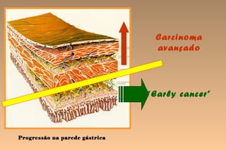 Carcinoma
                                 avançado




                                “Early cancer”



Progressão na parede gástrica
 