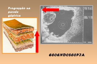 Progressão na
parede
gástrica




                ECOENDOSCOPIA
 