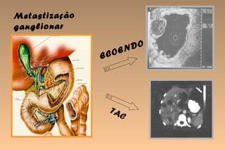 M eta sti za çã o
ga ng lio na r

                           EN DO
                    E CO




                      TA
                           C
 