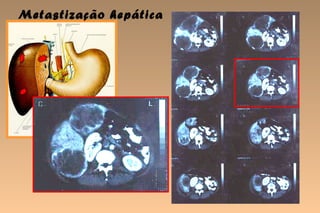 Metastização hepática
 