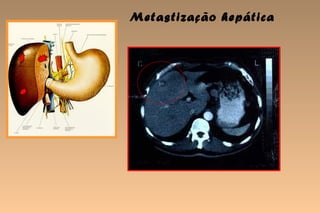 Metastização hepática
 