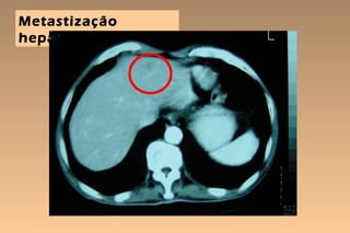 Metastização
hepática
 