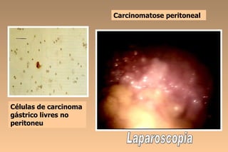 Carcinomatose peritoneal




Células de carcinoma
gástrico livres no
peritoneu
 