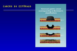 CANCRO DO ESTÔMAGO
 