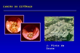 CANCRO DO ESTÔMAGO




                         Hospital S. João
                      Faculdade de Medicina
                       Serviço Cirurgia 4
                              Dir.:
                       Prof. Dr. Valdemar
                             Cardoso


                     J. Pinto de
                     Sousa
 