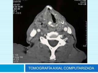 BUSQUEDA DE METASTASISDIAGNOSTICO