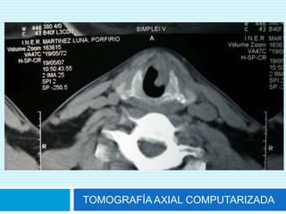 Indicaciones para laringoscopiaDisfonía de más de 2 a 3 semanas.Antecedente de tabaquismo y/o alcoholismo intensos.Síntomas asociados: disnea, disfagia, aspiración.Otros factores de riesgo para cáncer de laringe.