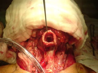 ESTADIFICACIÓN - TNM