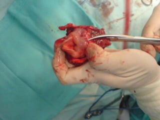 TRATAMIENTOMédicoRadioterapiaQuimioterapiaQuirúrgicoConservador: endolaringeo o cirugía abierta.Cordectomía vía laringofisuraHemilaringectomíaverticalLaringectomíasupraglótica horizontalLaringectomíasupracricoidea (CHEP)LaringectomíasubtotalRadicalLaringectomía Total